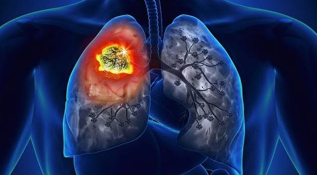 Akciğer kanseri önlenebilir