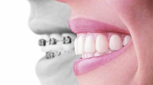 Diş dizilimi bozukluklarından kurtulmak çok kolay